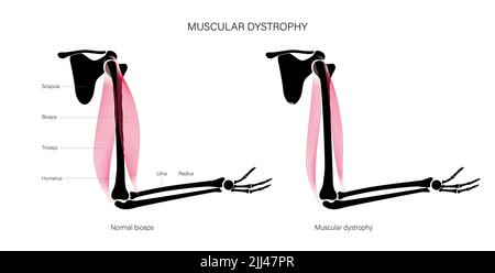 Muscular dystrophy, illustration. Stock Photo