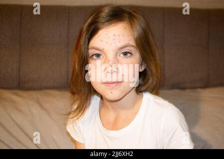 Natural vaccination. Contagious disease. Sick child with chickenpox. Varicella virus or Chickenpox bubble rash on child body and face. High quality photo Stock Photo