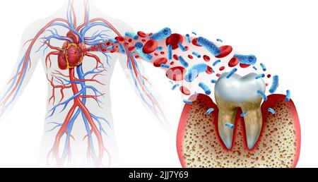 Tooth decay and heart disease as an unhealthy molar with periodontitis due to poor oral hygiene health problem as a bacteria infection in the blood. Stock Photo