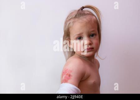 Burned arm of a little child, children burns injuries, cute trouble boy toddler with second- degree scald, copy space background Stock Photo