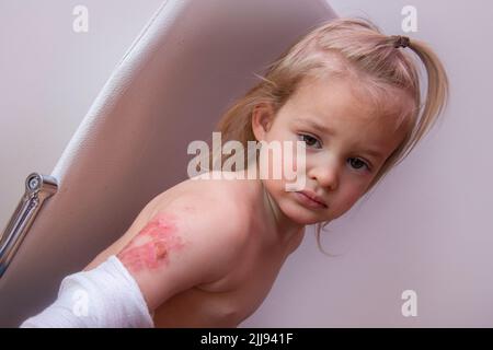 Burn injury in children, injured toddler with wounded arm Stock Photo