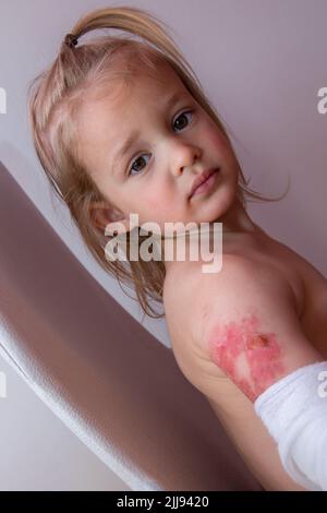 Toddler with burned wound on arm on white background, scalds and burns in a child Stock Photo