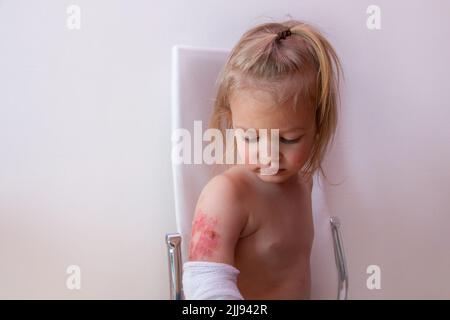 Toddler with burned wound on arm, scalds and burns in a child, empty space Stock Photo