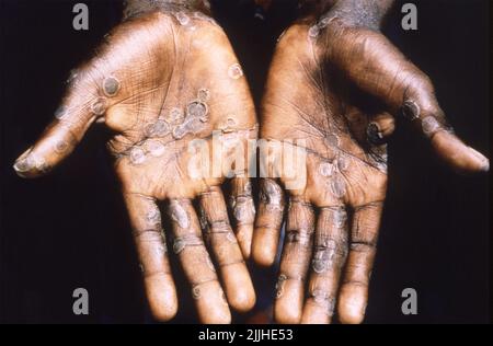 A man infected with monkeypox shows his palms displaying the characteristic rash and blisters during the recuperative stage of the viral disease taken in February 1997 in the Katako-Kombe Health Zone, Kasai Oriental, Democratic Republic of the Congo. Stock Photo