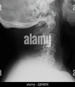 The vertical x-ray male cervical vertebrae. Medical concept. Stock Photo