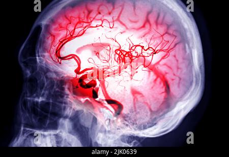 Skull image fusion with MRI MRA Brain  for evaluate them  stenosis  and stroke disease. Stock Photo