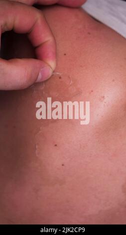 Peeling skin on human back also known as shedding or desquamation after over exposure to the summer sun and sunburn Stock Photo