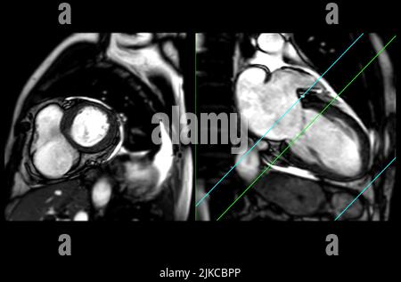 MRI heart or Cardiac MRI ( magnetic resonance imaging ) of heart in short axis and Vertical long axis view showing heart beating sa plane for detectin Stock Photo