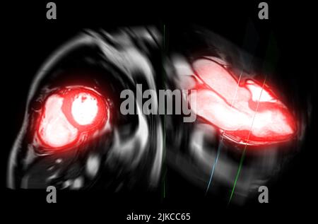 MRI heart or Cardiac MRI in short axis view showing cross-sections of ...