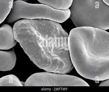Electron micrograph of red blood cells infected with Plasmodium falciparum, the parasite responsible for malaria in humans. During its development, the parasite forms projections called and quot Stock Photo