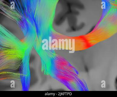 This spread spectrum imaging scan, which samples 257 directions over a range of different gradient strengths, shows tractography at a triple crossover in the white matter of the parietal lobe. Stock Photo