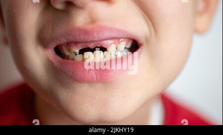 portrait of a boy with bad teeth, fallen front upper teeth Stock Photo