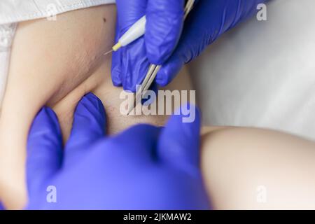 close-up in the doctor's hands medical tweezers and an electrode for hair removal using electrolysis in the armpit area Stock Photo