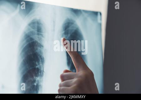 a finger pointing on a scan of lungs - closeup. High quality photo Stock Photo