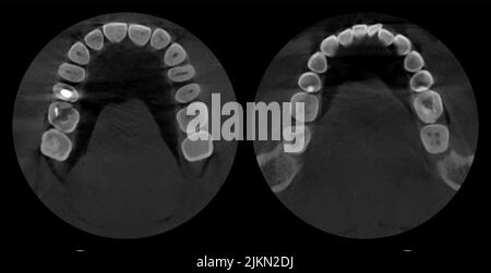 Teeth, realistic 3D scan jaw, dental MRI with caries, scanner picture. Dental x-ray examination graphic, new technologies in dentistry. Vector Stock Vector