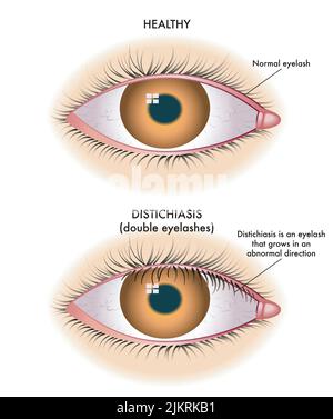 Medical illustration shows the comparison between a normal eye and one affected by distichiasis. Stock Vector