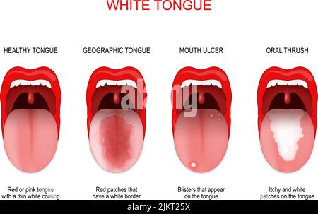 Sore or white tongue. comparison of healthy tongue and oral disease ...