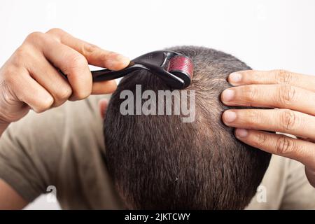 Man using dermaroller on bald patches for hair growth in white background. Stock Photo