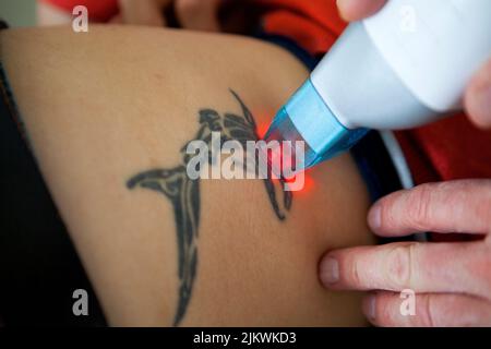 Fractional CO2 laser tattoo removal session in a beauty salon. Stock Photo