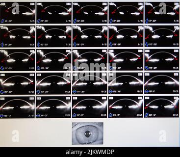 Corneal topographer for topography examination. Corneal topography eye ...