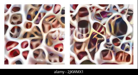 Illustration Comparing A Normal And Osteoporotic Bone The Osteoporotic Bone At Left Is A Porous