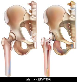 Femoral neck fracture (osteoporosis) and hip prosthesis. Stock Photo