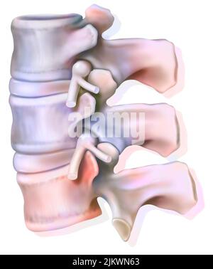 Lumbar nerve roots of the spinal nerves coming out of the lumbar vertebrae. Stock Photo