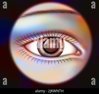 Eye: Implant permanently placed in the anterior chamber. Stock Photo