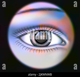 Eye: Implant permanently placed in the anterior chamber. Stock Photo