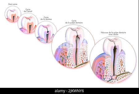 Tooth: formation and development of dental caries. Stock Photo