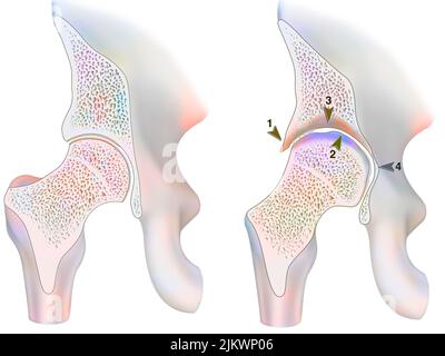 Healthy ankle and ankle with hemophilic arthropathy in frontal cut. Stock Photo