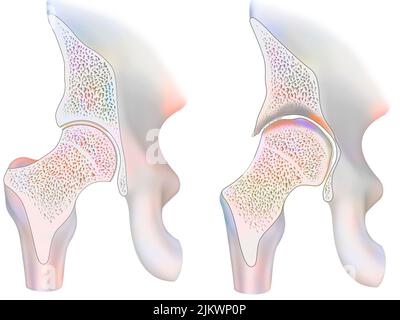 Healthy ankle and ankle with hemophilic arthropathy in frontal cut. Stock Photo