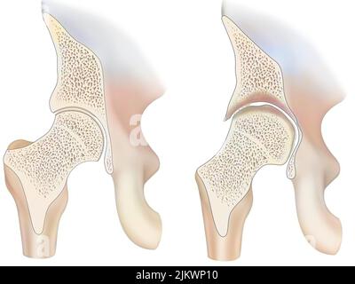 Healthy ankle and ankle with hemophilic arthropathy in frontal cut. Stock Photo