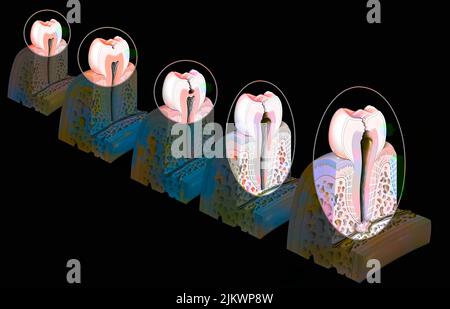 Tooth: formation and development of dental caries. Stock Photo