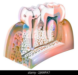 Dental plaque: main pathologies of the teeth: tartar, gingivitis, decay. Stock Photo