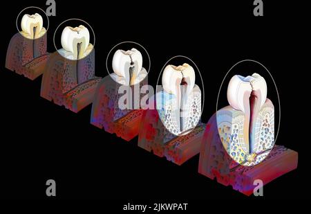 Tooth: formation and development of dental caries. Stock Photo