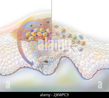 Treatment cream on a wart: stimulation of cytokine production. Stock Photo