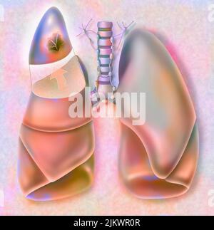 Removal of the apical segment of the right lung affected by a cancerous tumor. Stock Photo