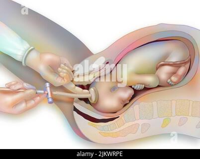 Vacuum cup hi-res stock photography and images - Alamy