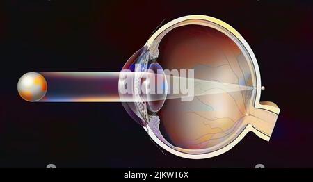 Hyperoptic Vision Hyperopic eye with the formation of the image behind the retina Stock ...