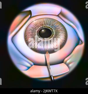 Intraocular implant, step 1: a small incision is made in the cornea. Stock Photo