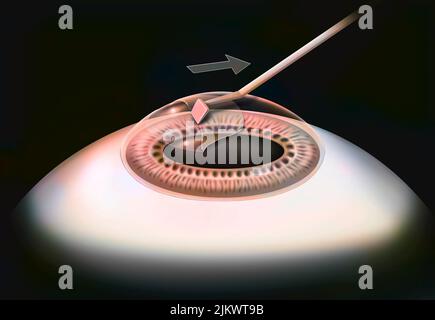 Eye, surgery, Lasek step 2: the corneal epithelium layer is detached ...