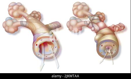 Asthma: healthy bronchiole (left) and asthmatic (right). Stock Photo