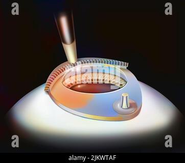 Eye, surgery, Lasik step 1: the microrobot is guided by a suction ring. Stock Photo