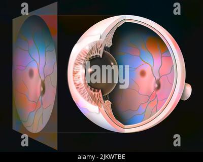 Eye, glaucoma: examination of a fundus with the result. Stock Photo