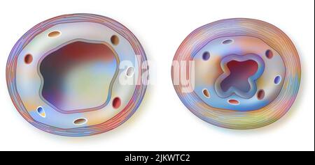 Asthma: healthy (left) and inflamed (right) bronchiole. Stock Photo