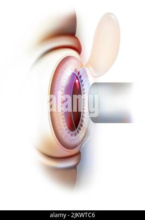 Eye: laser operation (here Lasik) to correct refractive errors. Stock Photo