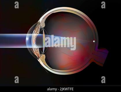 Eye, cataract: intraocular implants in anterior and posterior chamber. Stock Photo