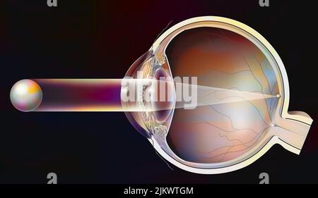 Normal vision in a healthy eye: the image forms on the retina. Stock Photo