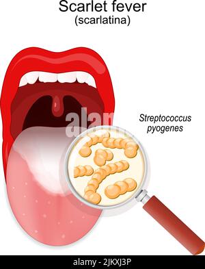 Scarlet fever mouth with symptoms of scarlatina Vector Image